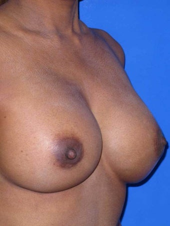 49 year old Malaysian female for XL Breast Augmentation before 921496
