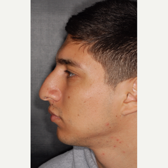 25-34 year old man treated with Septoplasty 3 years post-op before 3814064