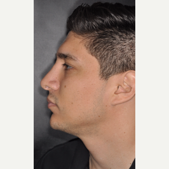 25-34 year old man treated with Septoplasty 3 years post-op after 3814064