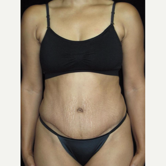 30 year old woman treated with Tummy Tuck after 3802787