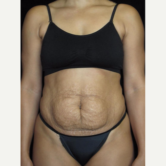 30 year old woman treated with Tummy Tuck before 3802787