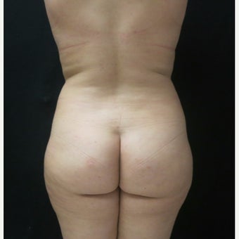 18-24 year old woman treated with Butt Augmentation, with Fat Transfer before 2043164