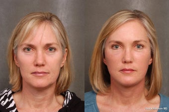 50 year old woman treated for early facial aging before 1497687