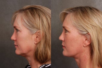 50 year old woman treated for early facial aging after 1497687