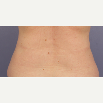 45-54 year old woman treated with CoolSculpting after 3711028