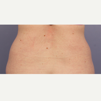 45-54 year old woman treated with CoolSculpting before 3711028