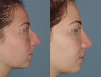 Female Patient, Early 20's, Treated for Lare Bump in Nose before 945502