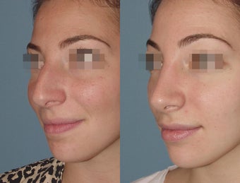 Female Patient, Early 20's, Treated for Lare Bump in Nose after 945502
