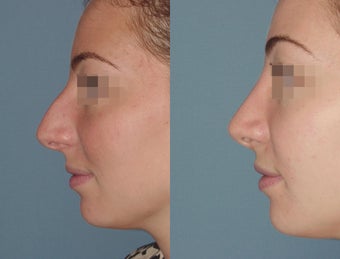Female Patient, Early 20's, Treated for Lare Bump in Nose 945502