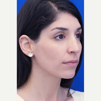 25-34 year old woman treated with Rhinoplasty before 2985953