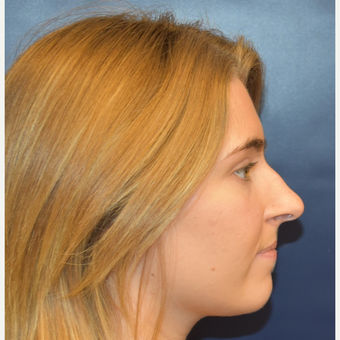 18-24 year old woman treated with Nose Surgery before 3251908