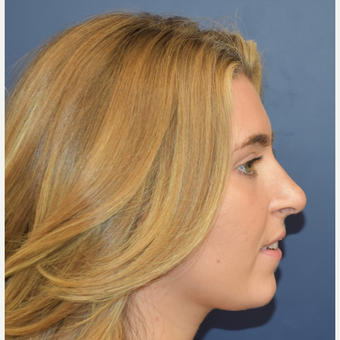 18-24 year old woman treated with Nose Surgery after 3251908