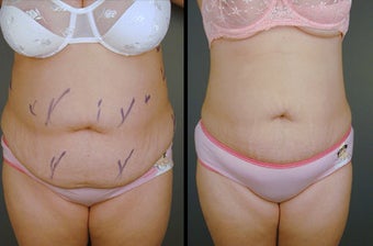 Tumescent Liposuction before 996373