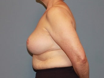 62 Year Old Breast Reduction Patient 1448282