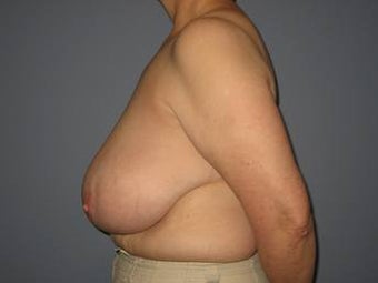 62 Year Old Breast Reduction Patient 1448282