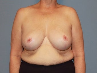 62 Year Old Breast Reduction Patient after 1448282
