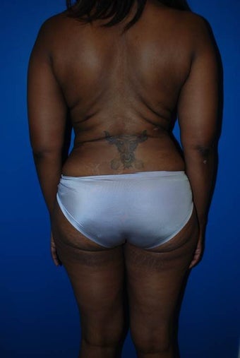 Liposuction of Back after 1181695