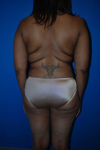 Liposuction of Back before 1181695