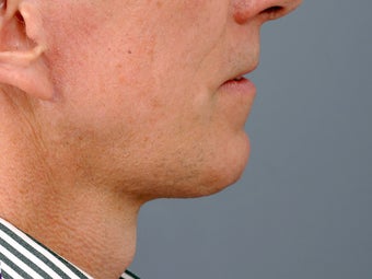 49 year old man with problem neck and 1 year after correction with necklift and lower facelift. after 1273414