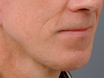 49 year old man with problem neck and 1 year after correction with necklift and lower facelift. 1273414