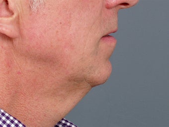 49 year old man with problem neck and 1 year after correction with necklift and lower facelift. before 1273414