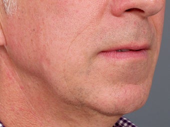 49 year old man with problem neck and 1 year after correction with necklift and lower facelift. 1273414