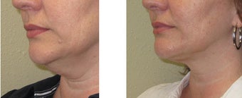 Chin liposuction/Liposculpture before 1007699