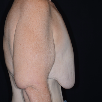 45-54 year old woman treated with Breast Reduction before 3810485