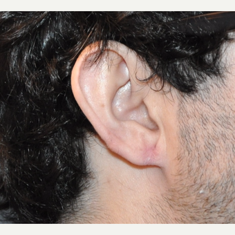 Stretched ("gauged") Ear Lobe Repair after 3732923