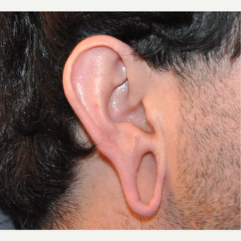 Stretched ("gauged") Ear Lobe Repair before 3732923