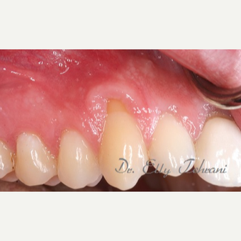 Gum recession on multiple teeth before 2955232