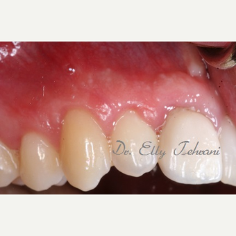 Gum recession on multiple teeth after 2955232