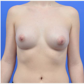 18-24 year old woman treated with Breast Augmentation after 3170862