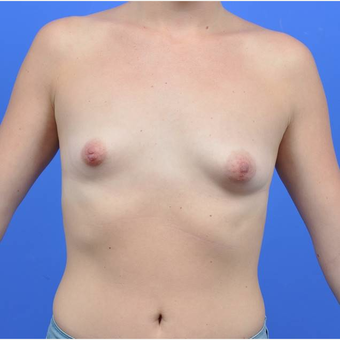 18-24 year old woman treated with Breast Augmentation before 3170862