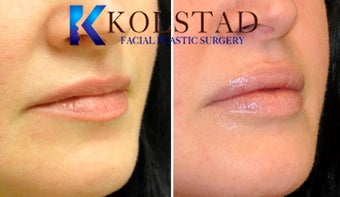 Natural Lip Augmentation 1260555