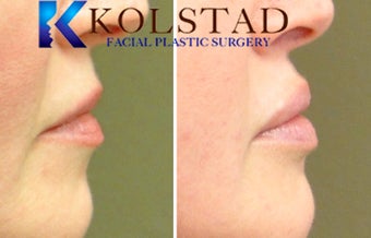 Natural Lip Augmentation after 1260555