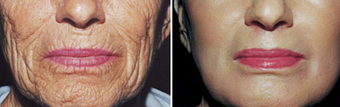 Chemical Peel before 1429293