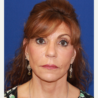 61 year old woman treated with Fat Transfer, face/neck lift, CO2 laser skin, upper eyelids after 3320545