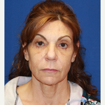 61 year old woman treated with Fat Transfer, face/neck lift, CO2 laser skin, upper eyelids before 3320545