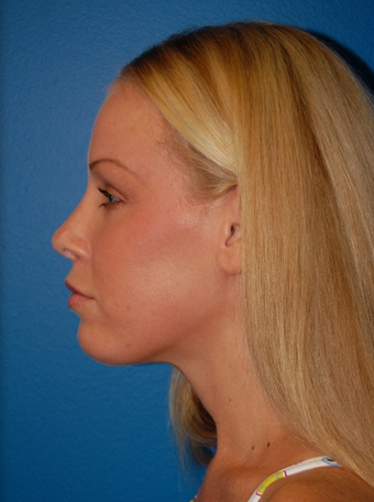 Revision Rhinoplasty after 1252139