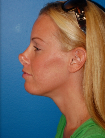 Revision Rhinoplasty before 1252139
