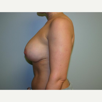 Breast Augmentation after 3560708