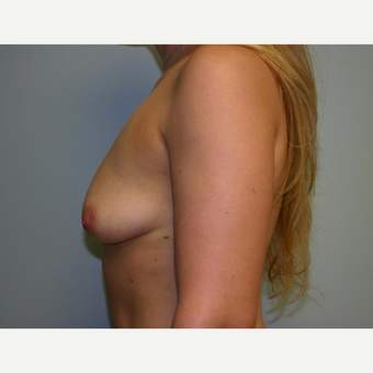 Breast Augmentation before 3560708