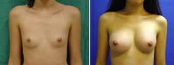 Breast Augmentation before 8973
