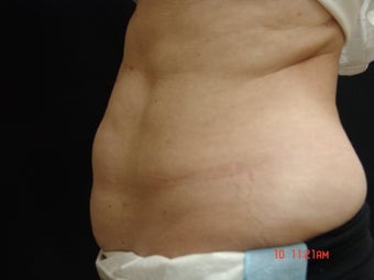 Coolsculpting before 495175