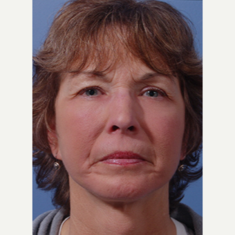 55-64 year old woman treated with Facelift after 3783068
