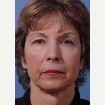 55-64 year old woman treated with Facelift before 3783068