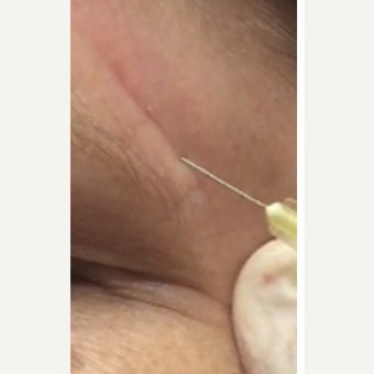 45-54 year old woman treated with Scar Removal before 2491021