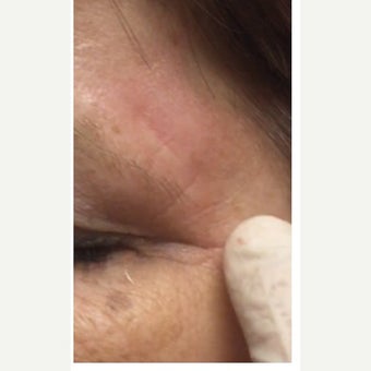 45-54 year old woman treated with Scar Removal after 2491021
