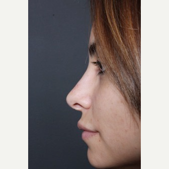 25-34 year old woman treated with Non Surgical Nose Job after 3590825